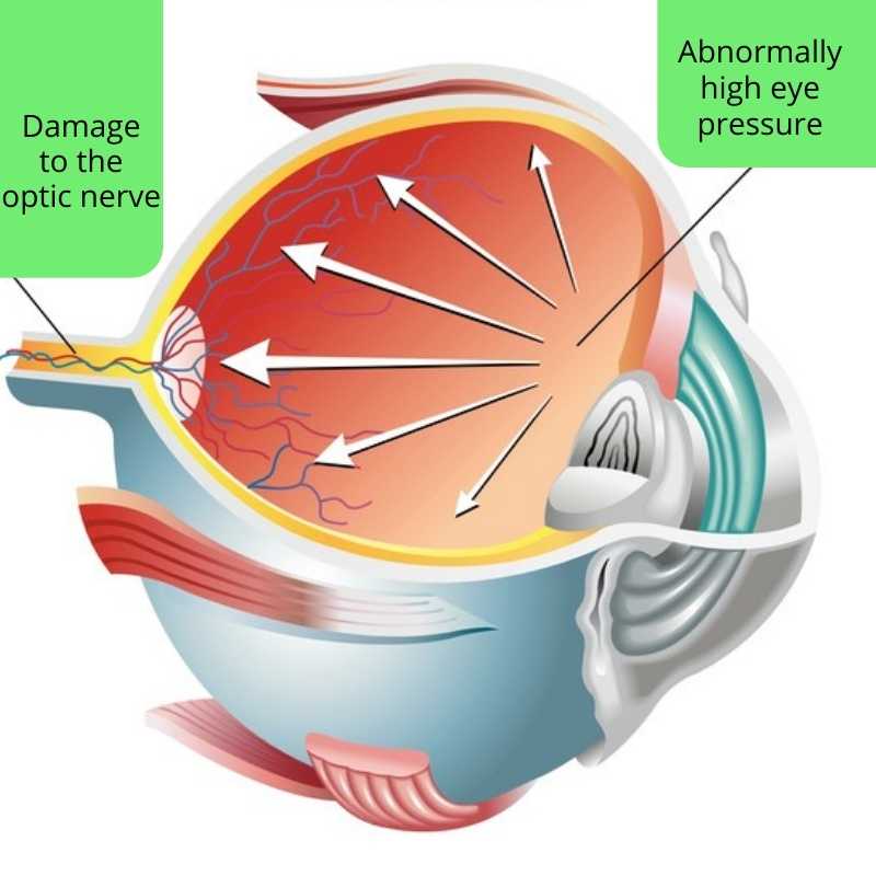 Glaucoma - Kesona Eye Centre